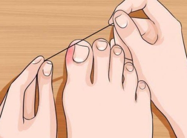 CHĂM SÓC MÓNG CHÂN ĐÚNG CÁCH – TRÁNH MÓNG MỌC ĐÂM VÀO THỊT (MÓNG MỌC NGƯỢC)