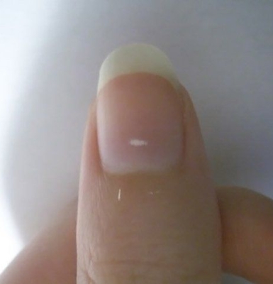 Móng Tay Có Đốm Trắng – Điềm Báo Sức Khỏe Hay Chỉ Là Những Va Đập Thông Thường?