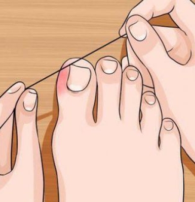 CHĂM SÓC MÓNG CHÂN ĐÚNG CÁCH – TRÁNH MÓNG MỌC ĐÂM VÀO THỊT (MÓNG MỌC NGƯỢC)