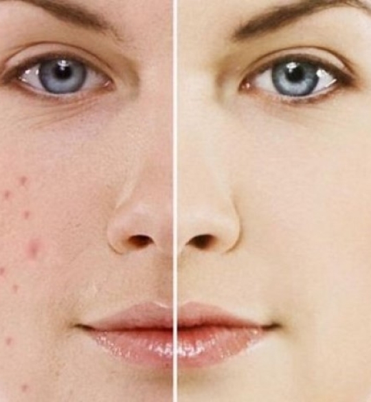 điều trị mụn trứng cá